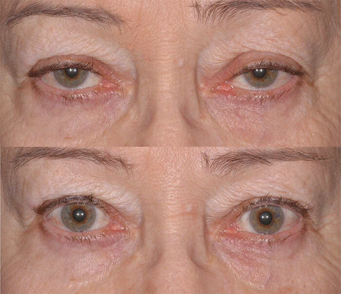 Ptosis