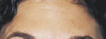 Forehead After Botox