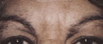 Forehead After Botox #2