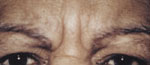 Forehead Before Botox