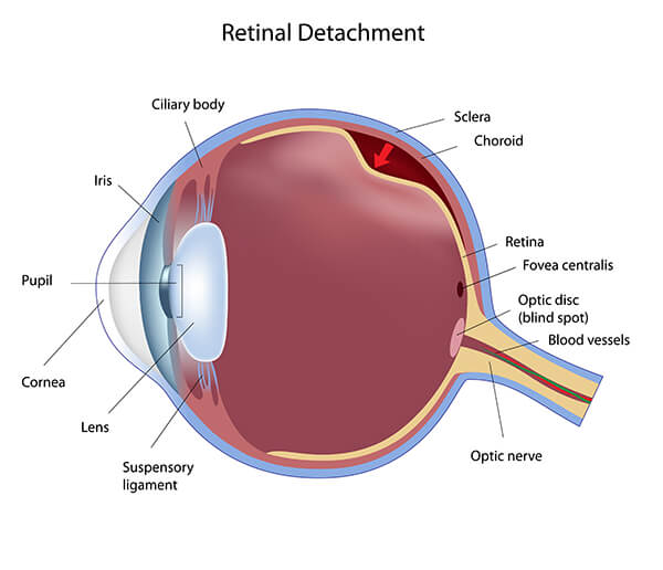 Retinal Detachment Example