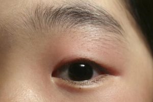 Ever wake up with a swollen, puffy eyelid? A tender, painful, swollen eyelid?