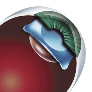Implantable Contact Lens Animation