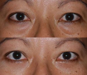 Lower Eyelid Blepharoplasty Before and After