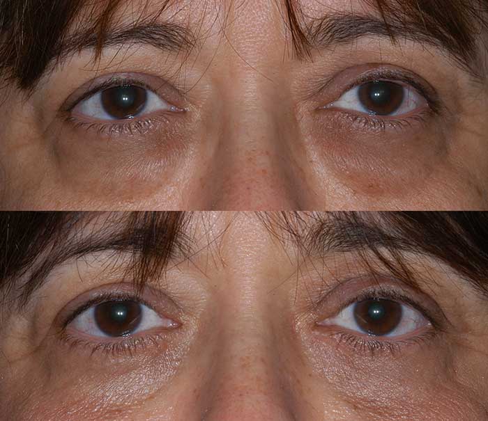 Lower Eyelid Blepharoplasty Example #4