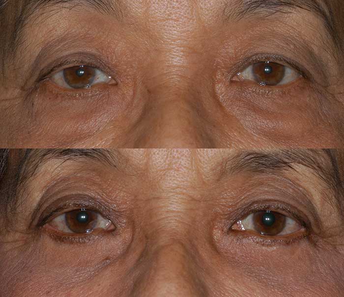 Lower Eyelid Blepharoplasty Example #3