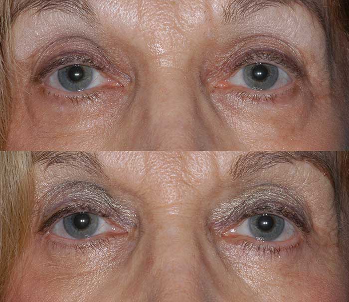 Lower Eyelid Blepharoplasty Example #2