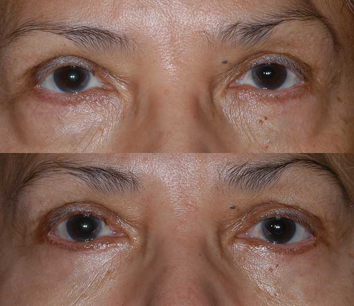Blepharoplasty Miami Lower Eyelid Blepharoplasty Example #1