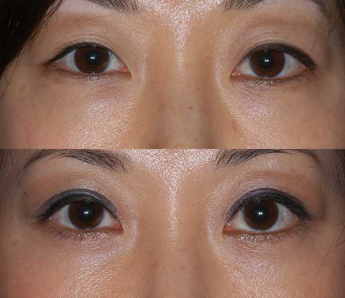 Lower Eyelid Blepharoplasty Example #6